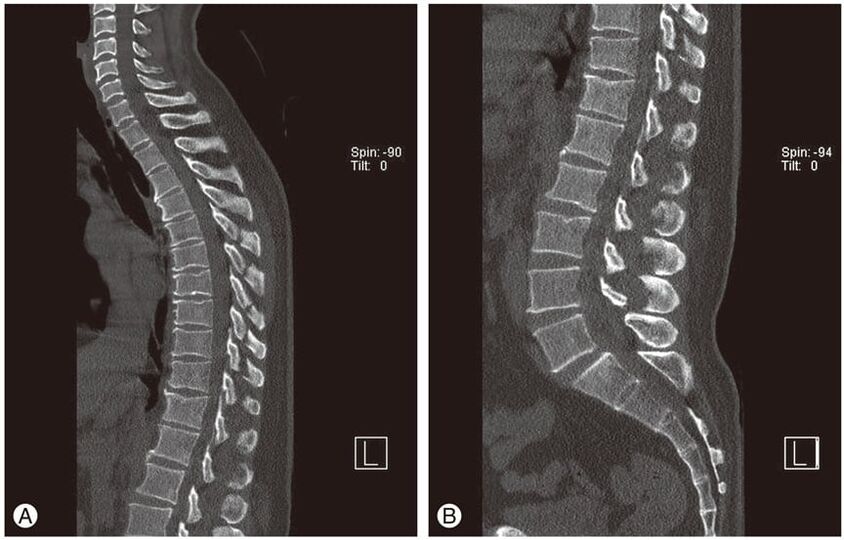 Verformung der Bandscheiben auf MRT-Bildern bei thorakaler Osteochondrose