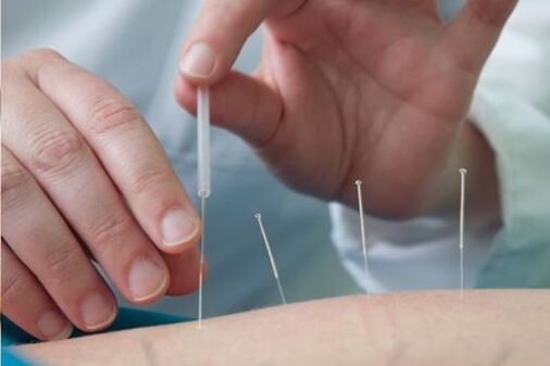 Akupunktur - eine Methode zur Behandlung von Schmerzen in der Lendengegend, die durch Osteochondrose verursacht werden