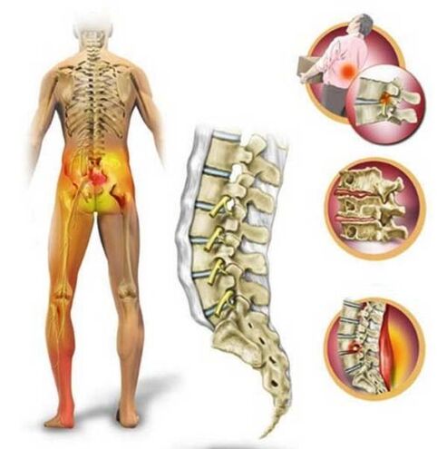 Osteochondrose der Lendenwirbelsäule, die Rückenschmerzen verursacht