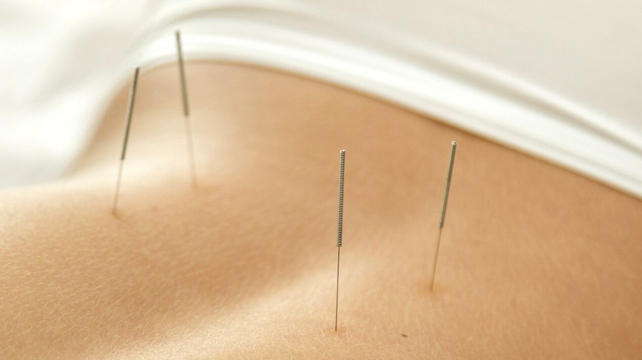 Akupunktur hilft, Schmerzen im unteren Rückenbereich loszuwerden